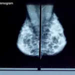 Mammogram Image