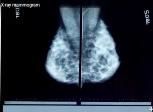 Breast cancer screening icd10
