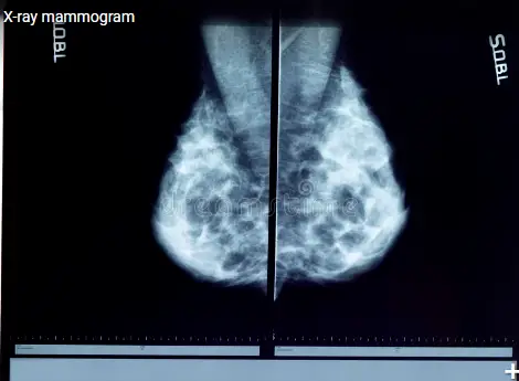 mammogram microcalcification icd 10